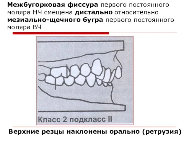 Межбугорковая фиссура первого постоянного моляра НЧ смещена дистально относительно мезиально-щечного бугра