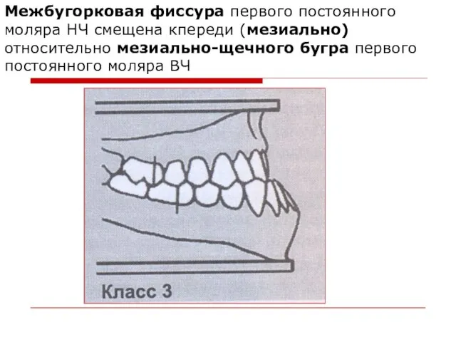 Межбугорковая фиссура первого постоянного моляра НЧ смещена кпереди (мезиально) относительно мезиально-щечного бугра первого постоянного моляра ВЧ