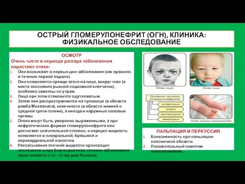 ОСТРЫЙ ГЛОМЕРУЛОНЕФРИТ (ОГН), КЛИНИКА: ФИЗИКАЛЬНОЕ ОБСЛЕДОВАНИЕ ОСМОТР Очень часто в периоде