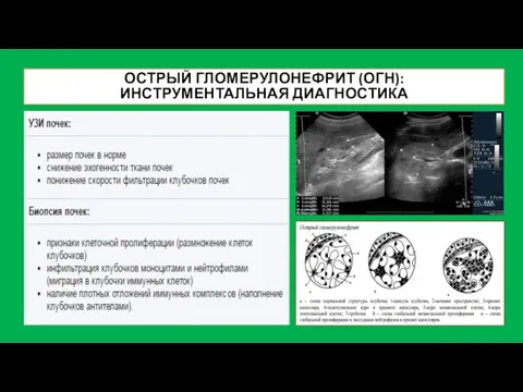 ОСТРЫЙ ГЛОМЕРУЛОНЕФРИТ (ОГН): ИНСТРУМЕНТАЛЬНАЯ ДИАГНОСТИКА