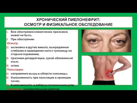 ХРОНИЧЕСКИЙ ПИЕЛОНЕФРИТ: ОСМОТР И ФИЗИКАЛЬНОЕ ОБСЛЕДОВАНИЕ Вне обострения клинических признаков может