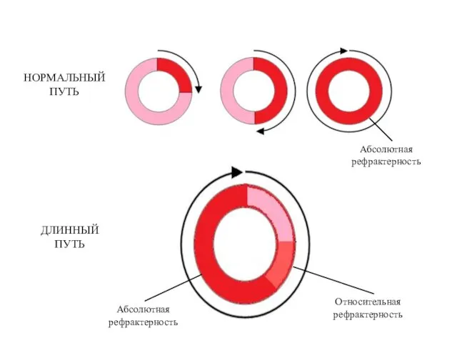 НОРМАЛЬНЫЙ ПУТЬ ДЛИННЫЙ ПУТЬ Абсолютная рефрактерность Абсолютная рефрактерность Относительная рефрактерность