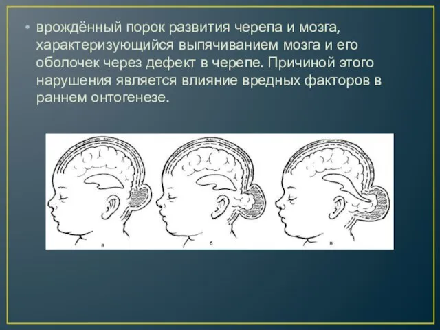 врождённый порок развития черепа и мозга, характеризующийся выпячиванием мозга и его