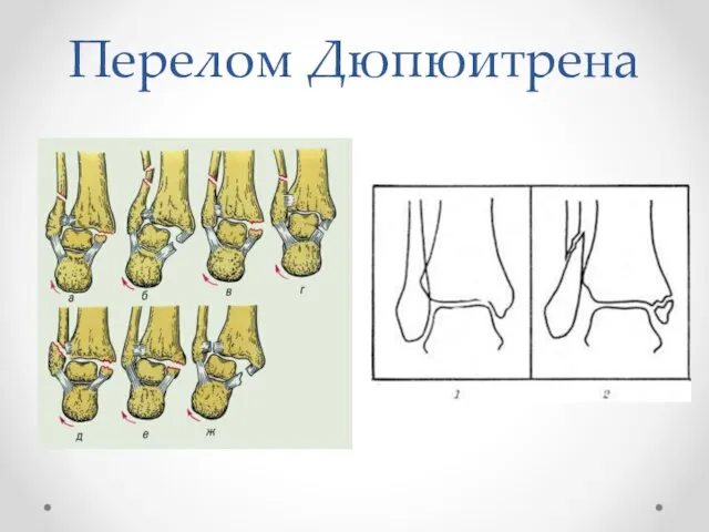 Перелом Дюпюитрена