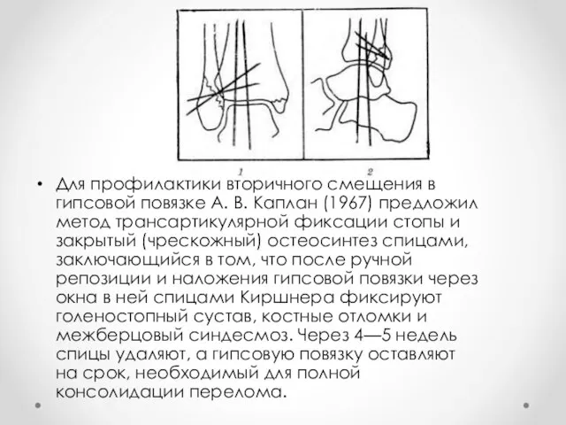 Для профилактики вторичного смещения в гипсовой повязке А. В. Каплан (1967)