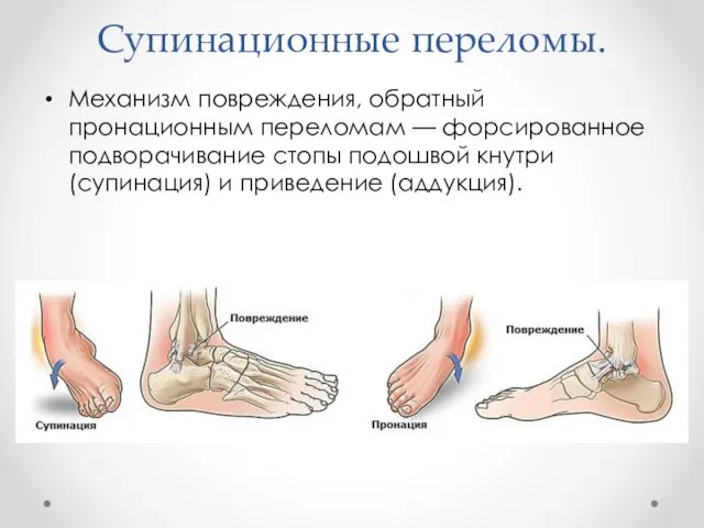 Супинационные переломы. Механизм повреждения, обратный пронационным переломам — форси­рованное подворачивание стопы