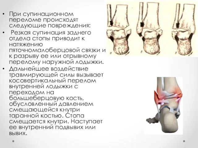 При супинационном переломе происходят следующие повреждения: Резкая супинация заднего отдела стопы