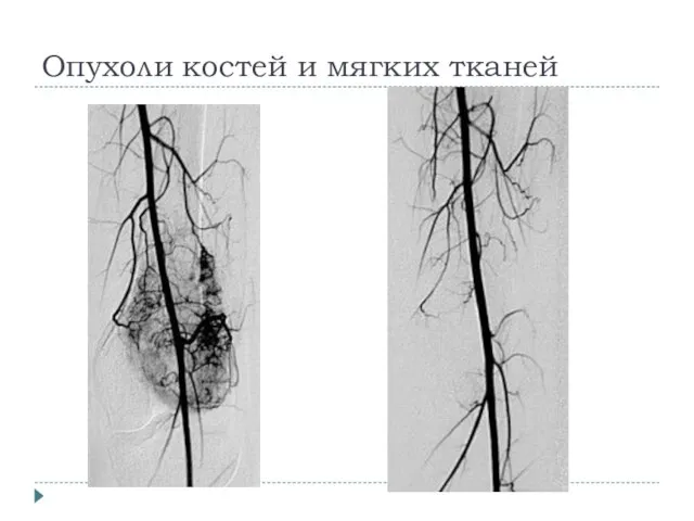 Опухоли костей и мягких тканей