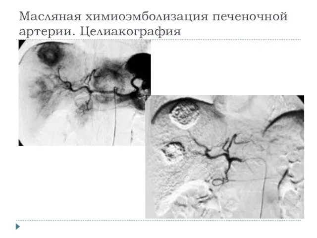 Масляная химиоэмболизация печеночной артерии. Целиакография