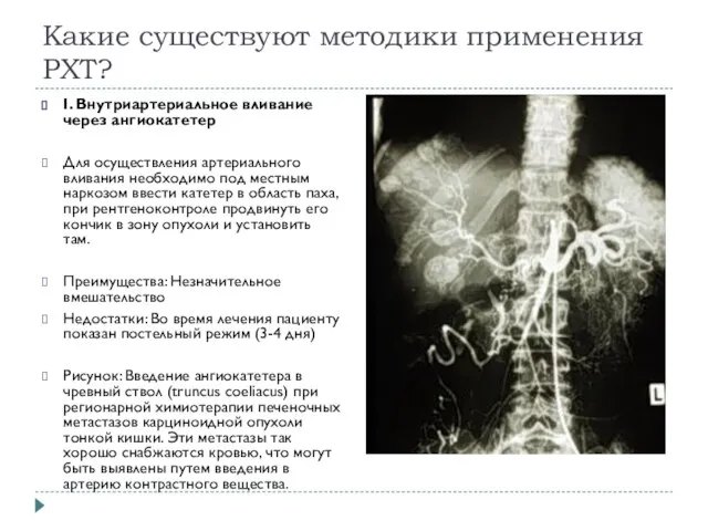 Какие существуют методики применения РХТ? I. Внутриартериальное вливание через ангиокатетер Для