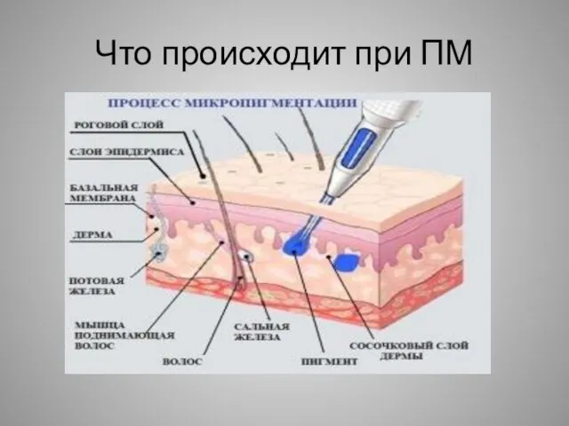 Что происходит при ПМ