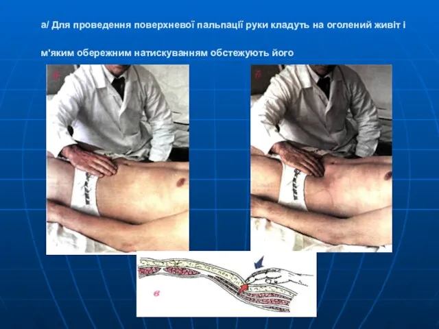 а/ Для проведення поверхневої пальпації руки кладуть на оголений живіт і м'яким обережним натискуванням обстежують його