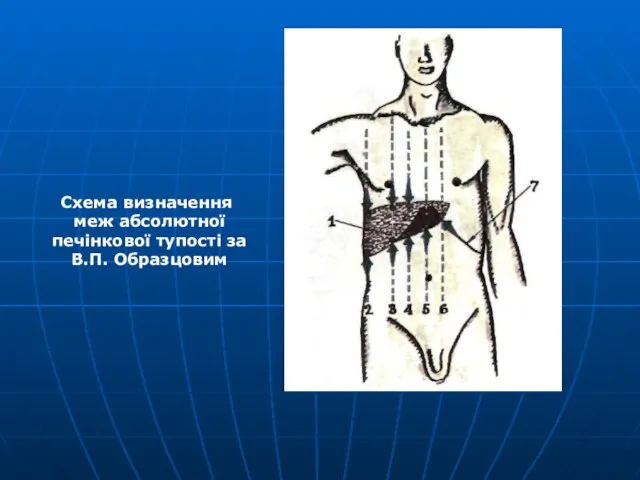 Схема визначення меж абсолютної печінкової тупості за В.П. Образцовим