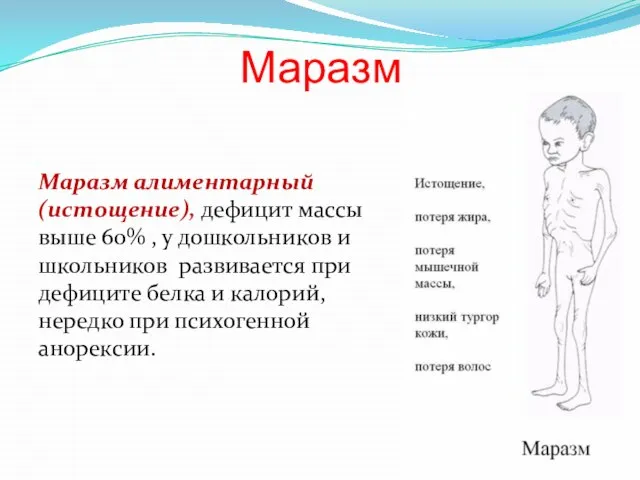 Маразм Маразм алиментарный (истощение), дефицит массы выше 60% , у дошкольников