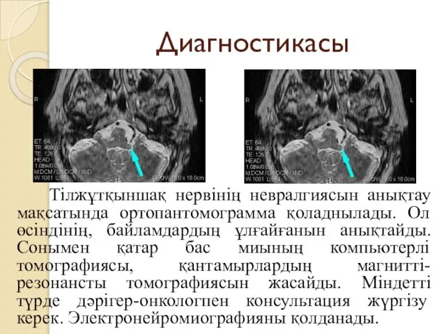 Диагностикасы Тілжұтқыншақ нервінің невралгиясын анықтау мақсатында ортопантомограмма қоладнылады. Ол өсіндінің, байламдардың