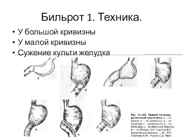 Бильрот 1. Техника. У большой кривизны У малой кривизны Сужение культи желудка