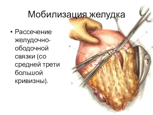 Мобилизация желудка Рассечение желудочно-ободочной связки (со средней трети большой кривизны).