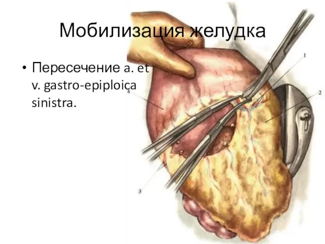 Мобилизация желудка Пересечение a. et v. gastro-epiploica sinistra.