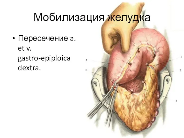 Мобилизация желудка Пересечение a. et v. gastro-epiploica dextra.