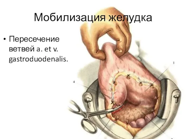 Мобилизация желудка Пересечение ветвей a. et v. gastroduodenalis.