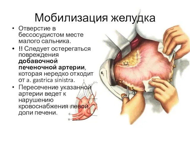 Мобилизация желудка Отверстие в бессосудистом месте малого сальника. !! Следует остерегаться