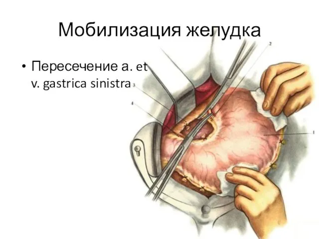 Мобилизация желудка Пересечение а. et v. gastrica sinistra