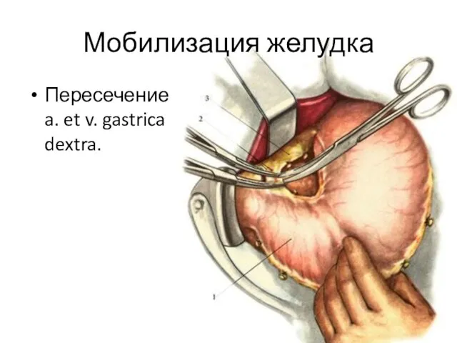 Мобилизация желудка Пересечение a. et v. gastrica dextra.