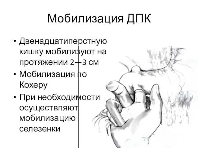 Мобилизация ДПК Двенадцатиперстную кишку мобилизуют на протяжении 2—3 см Мобилизация по