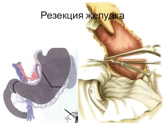 Резекция желудка