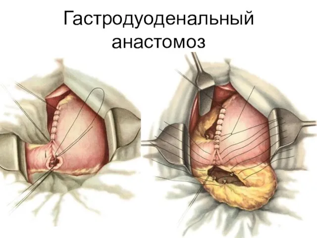 Гастродуоденальный анастомоз