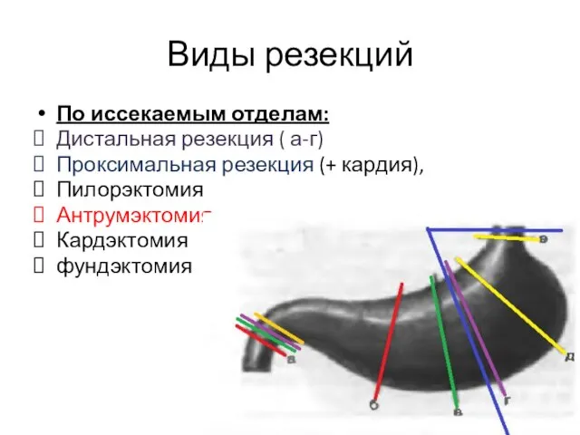 Виды резекций По иссекаемым отделам: Дистальная резекция ( а-г) Проксимальная резекция