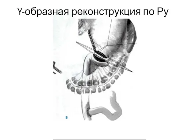 Y-образная реконструкция по Ру