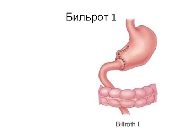 Бильрот 1