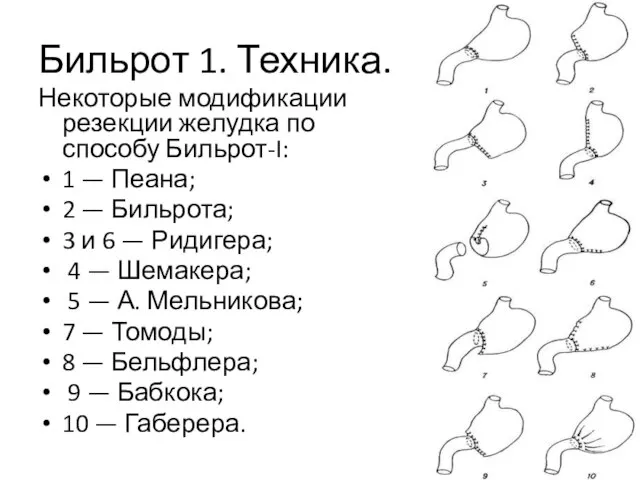 Бильрот 1. Техника. Некоторые модификации резекции желудка по способу Бильрот-I: 1