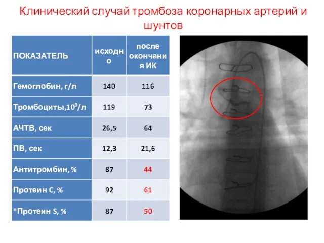 Клинический случай тромбоза коронарных артерий и шунтов