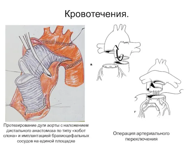 Протезирование дуги аорты с наложением дистального анастомоза по типу «хобот слона»