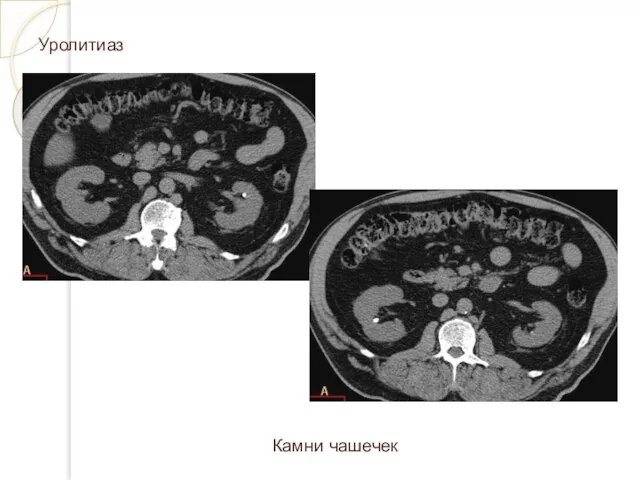 Уролитиаз Камни чашечек