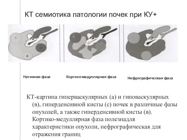 КТ семиотика патологии почек при КУ+ КТ-картина гиперваскулярных (а) и гиповаскулярных