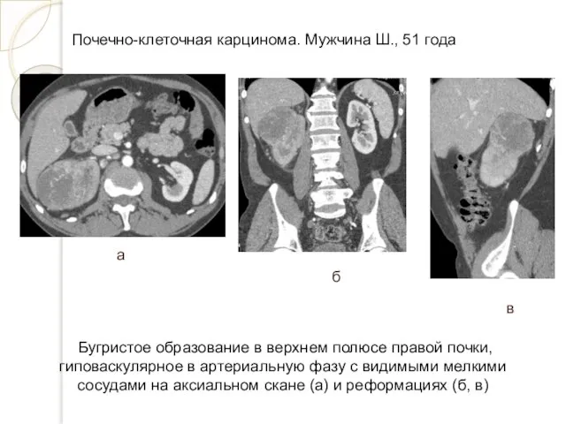 Почечно-клеточная карцинома. Мужчина Ш., 51 года Бугристое образование в верхнем полюсе