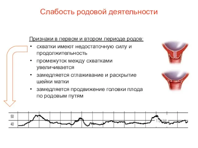 Слабость родовой деятельности Признаки в первом и втором периоде родов: схватки