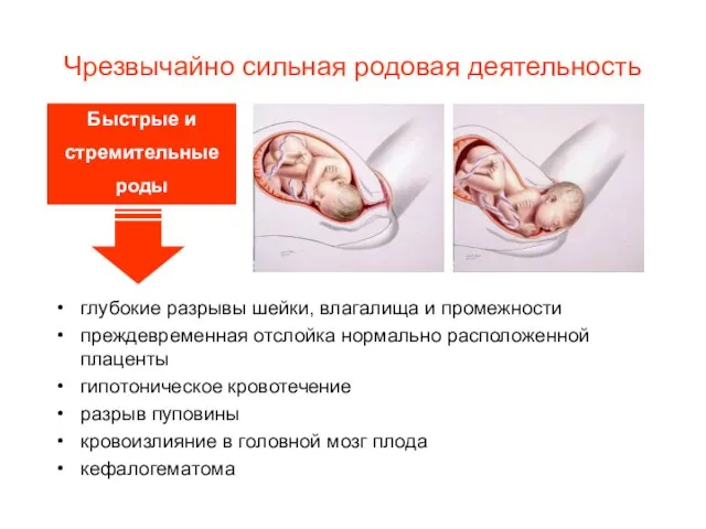 Чрезвычайно сильная родовая деятельность глубокие разрывы шейки, влагалища и промежности преждевременная