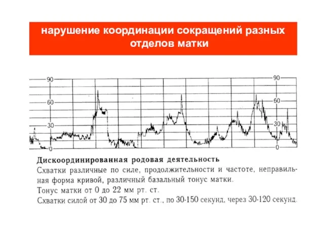 нарушение координации сокращений разных отделов матки