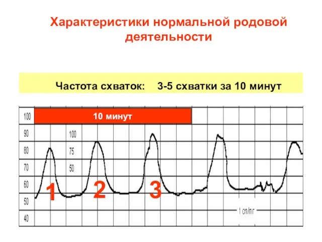 Характеристики нормальной родовой деятельности Частота схваток: 3-5 схватки за 10 минут 10 минут 1 2 3