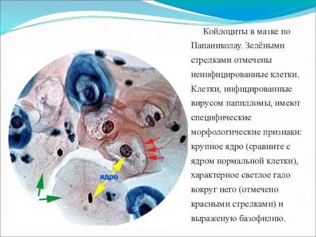 Койлоциты в мазке по Папаниколау. Зелёными стрелками отмечены неинфицированные клетки. Клетки,