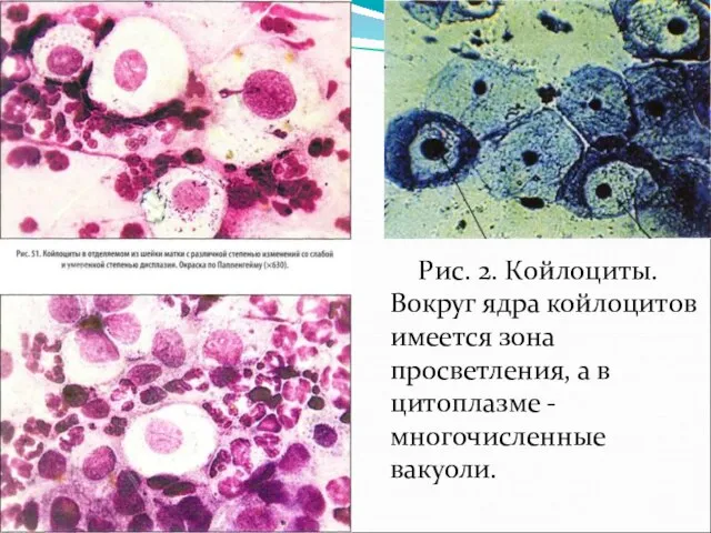 Рис. 2. Койлоциты. Вокруг ядра койлоцитов имеется зона просветления, а в цитоплазме - многочисленные вакуоли.