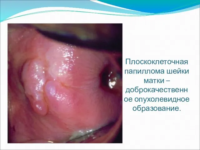 Плоскоклеточная папиллома шейки матки – доброкачественное опухолевидное образование.