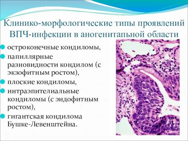 Клинико-морфологические типы проявлений ВПЧ-инфекции в аногенитапьной области остроконечные кондиломы, папиллярные разновидности