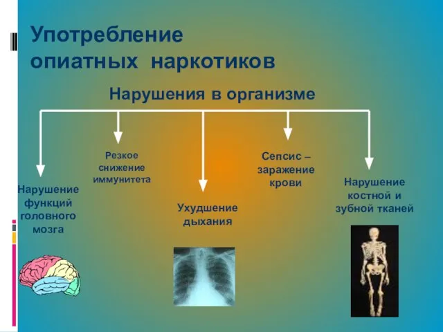 Употребление опиатных наркотиков Нарушение функций головного мозга Нарушение костной и зубной