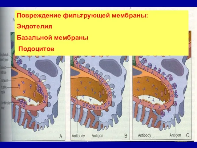 Повреждение фильтрующей мембраны: Эндотелия Базальной мембраны Подоцитов