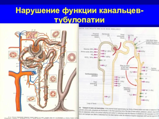 Нарушение функции канальцев- тубулопатии